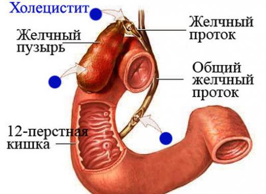 Що таке холецистит?