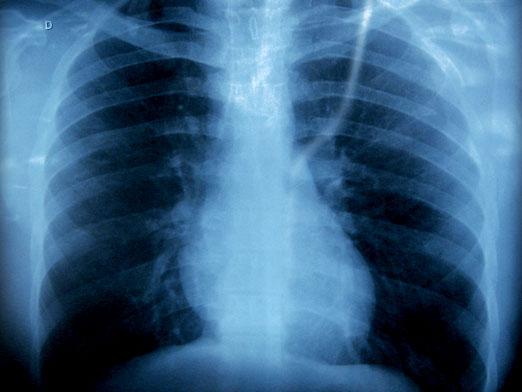 Як часто можна робити рентген?